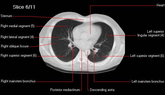 Slice Thickness Research on Computed Tomography (CT) Images